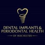 DENTAL IMPLANTS And PERIODONTAL HEALTH